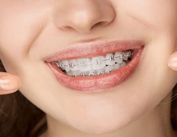 Golnick Pediatric Dentistry: Metal Vs.Tooth-colored Fillings