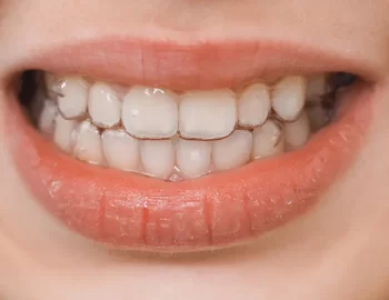 Bruxism (Tooth Grinding): Can It Cause Severe Toothache?