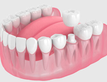 Should kids get crowns on their teeth?