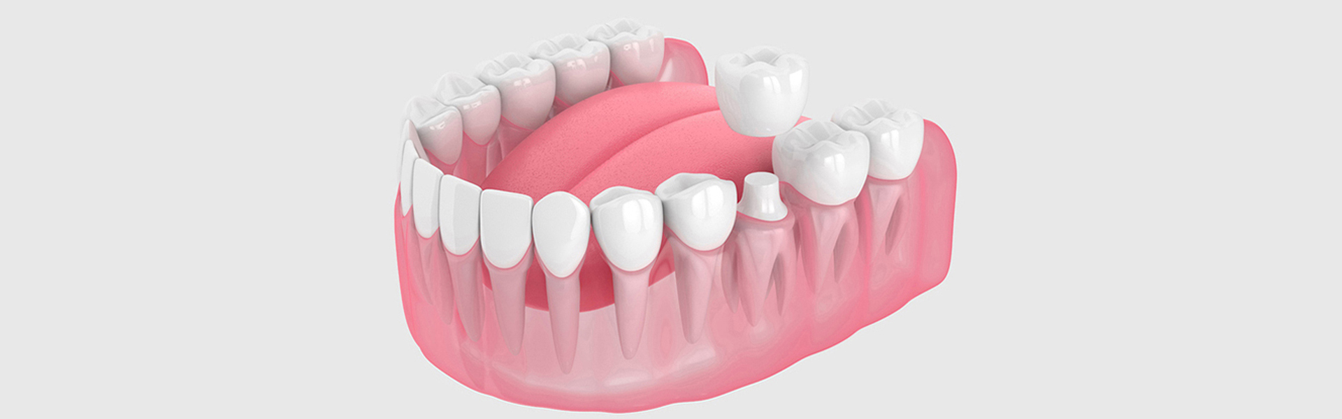 Should kids get crowns on their teeth?